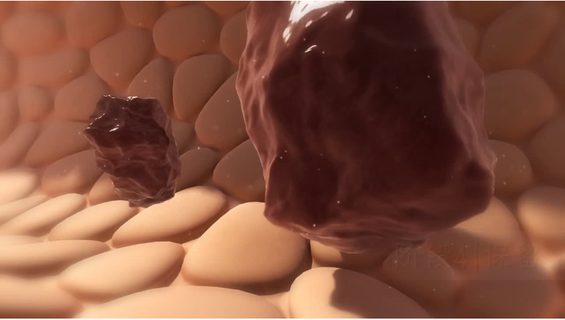 【醫(yī)學動畫】醫(yī)療宣傳片產品結石形成三維3D動畫視頻制作