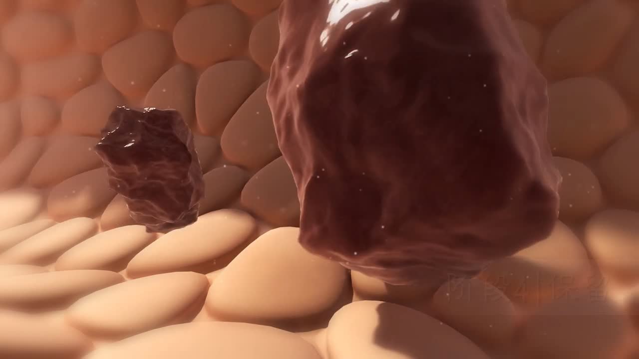 【医学动画】医疗宣传片产品结石形成三维3D动画视频制作